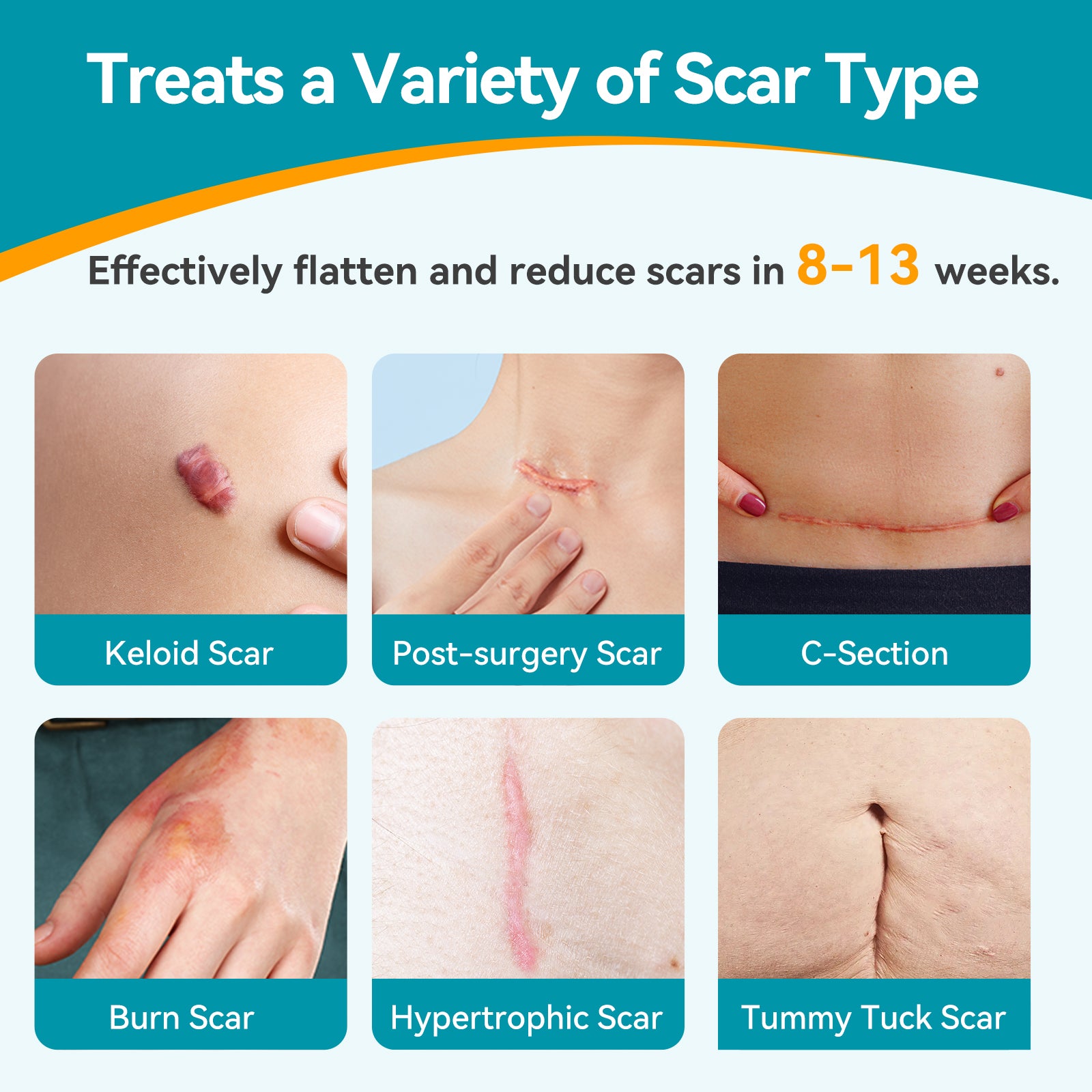 Dimora UPF50+ Silicone Scar Sheets with UV Protection for Surgical, C-Section & Keloid Scars,