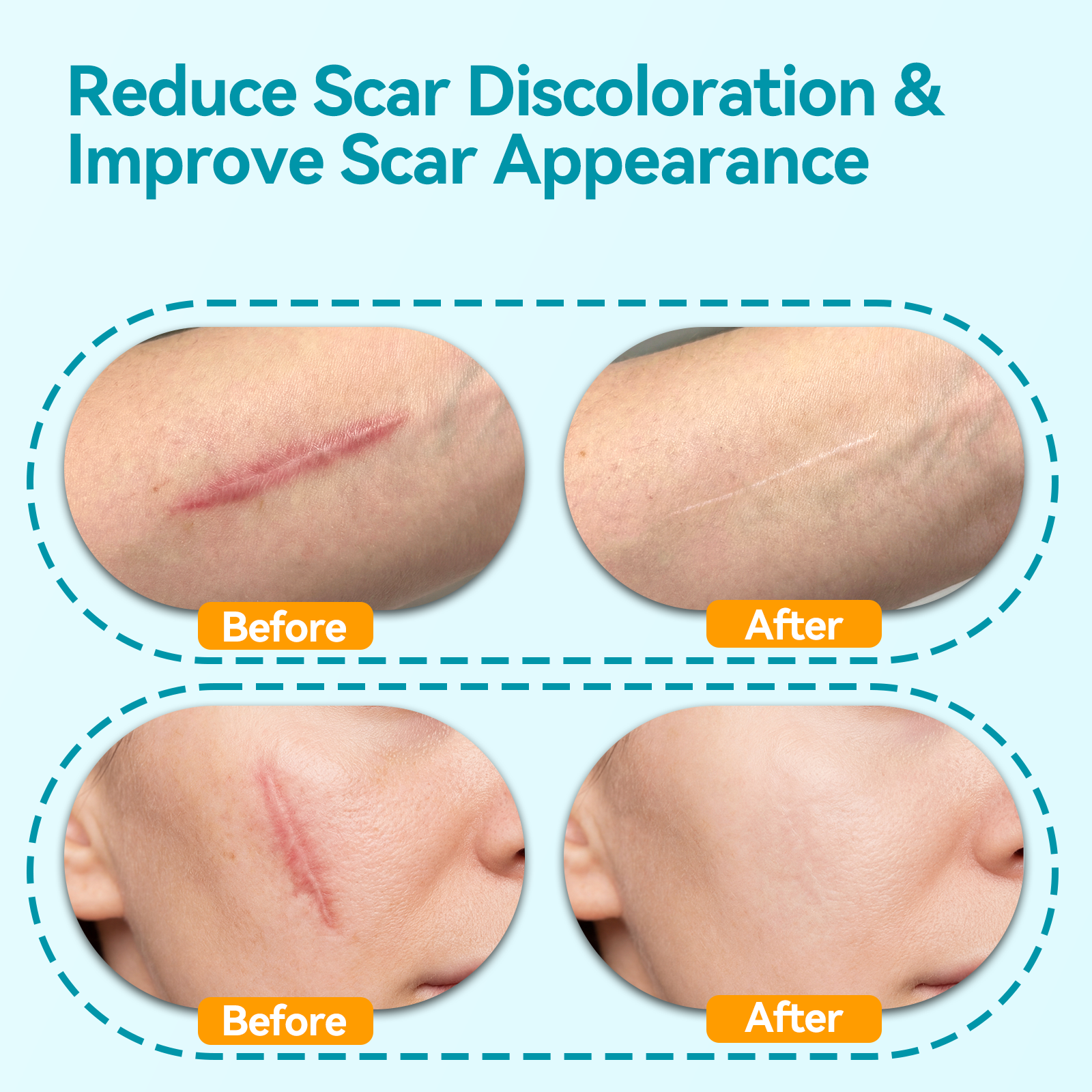 Dimora UPF50+ Silicone Scar Sheets with UV Protection for Surgical, C-Section & Keloid Scars,
