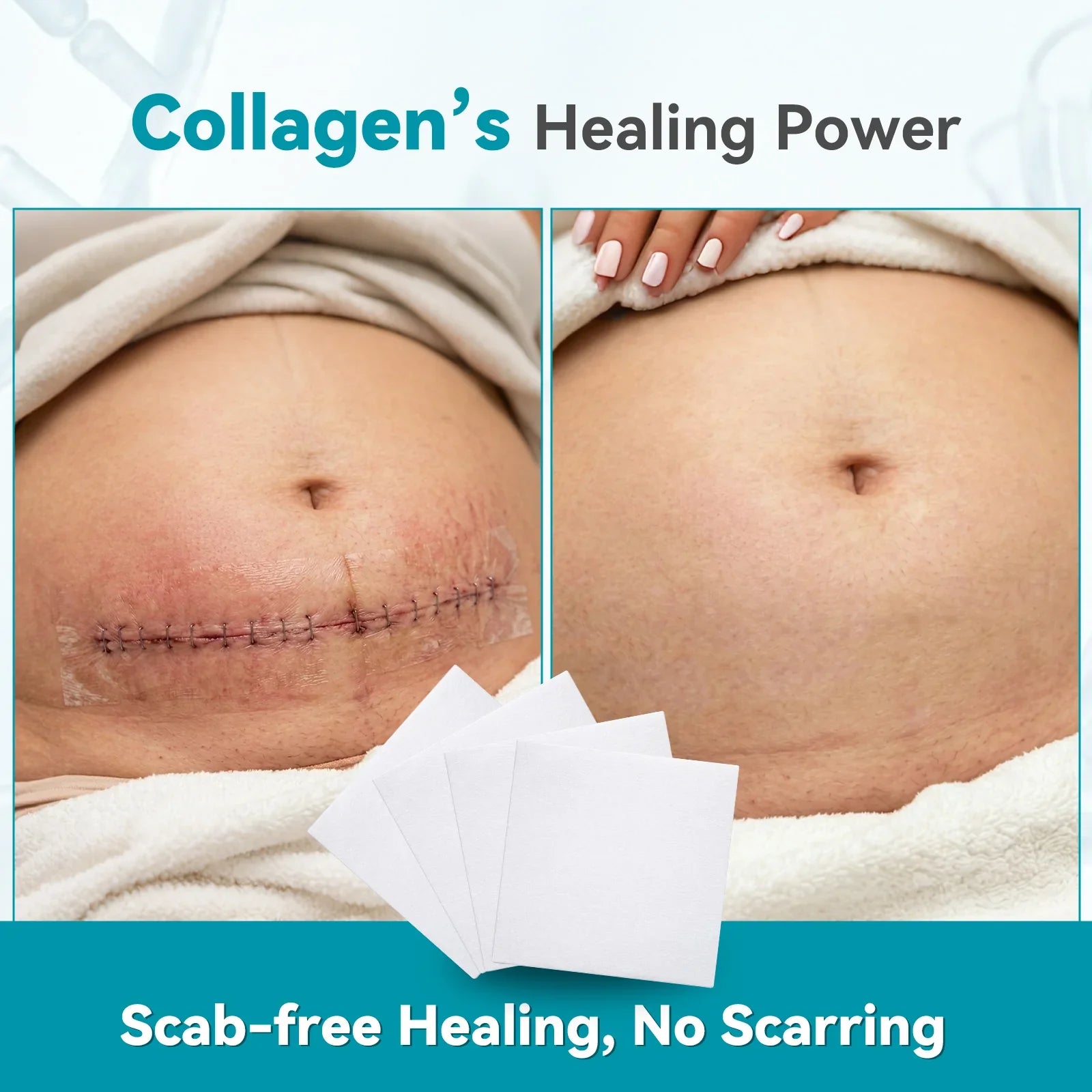 Before and after wound healing on abdomen using collagen dressing, scar visibly reduced.