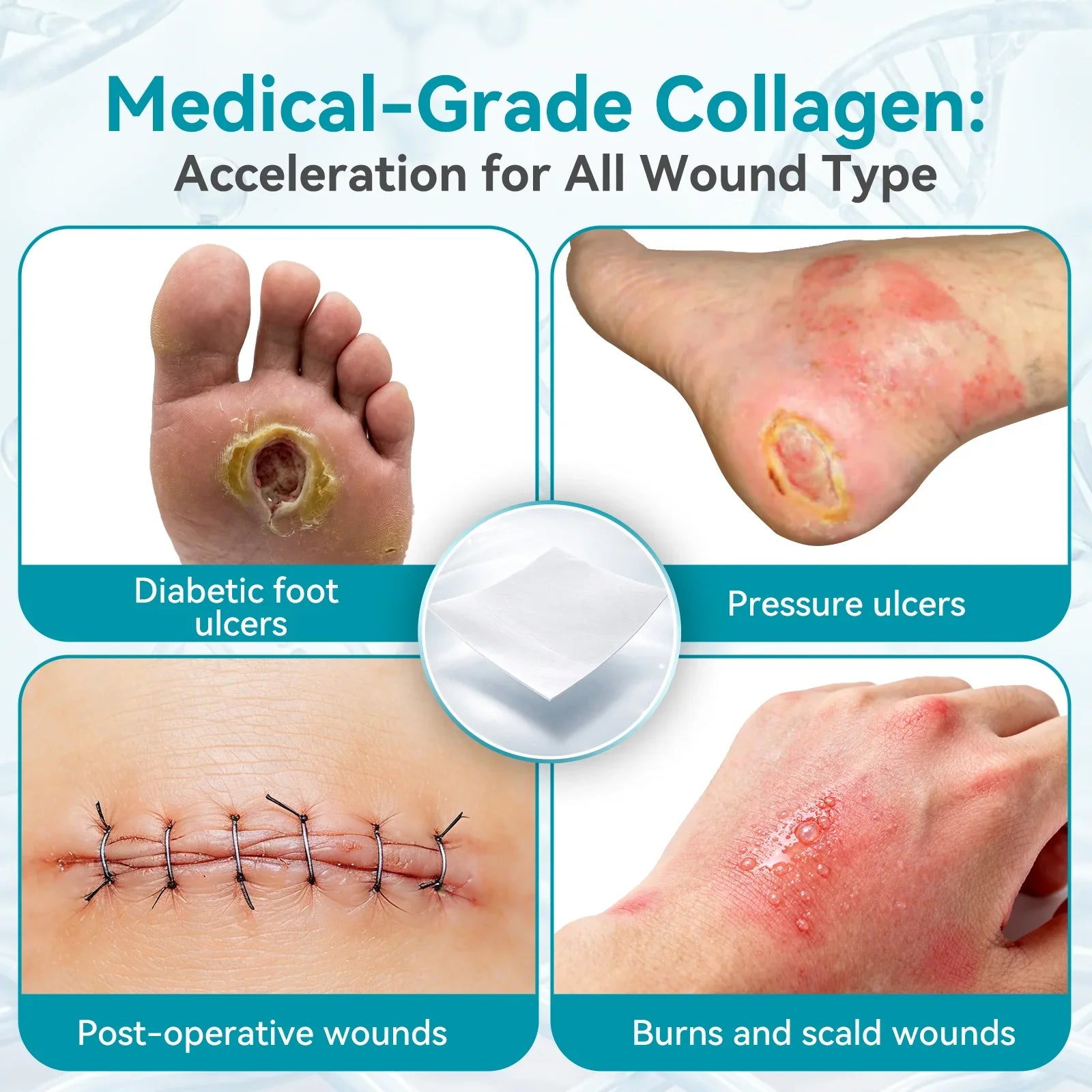 Medical-grade collagen for wound care, showing diabetic foot ulcers, pressure ulcers, post-operative wounds, burns and scald wounds.