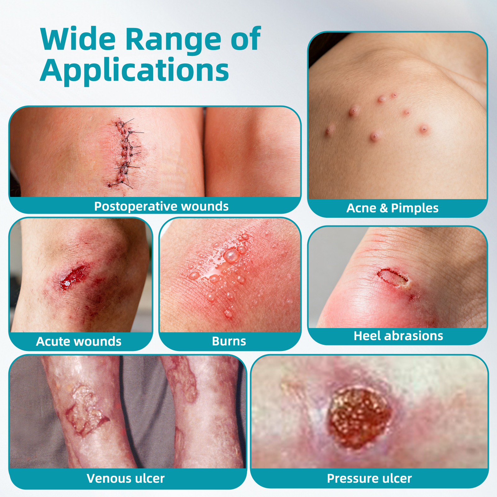 Dimora Medical Grade Hydrocolloid Roll (2in*16ft), Highly Absorbent Hydrocolloid Bandages for Wound Care, Burn, Blister, Acne Care, Waterproof & Cut to Size